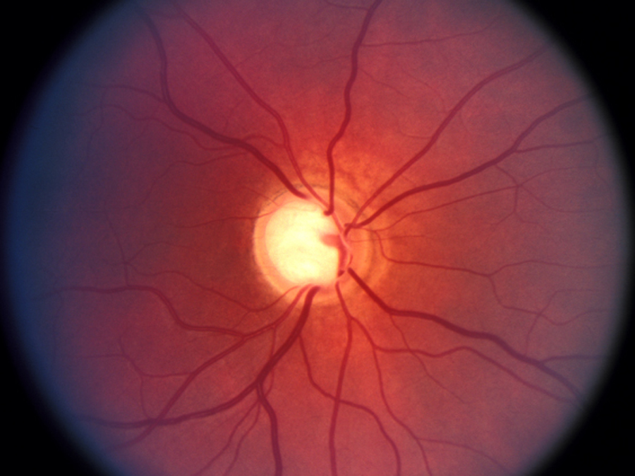 Кровообращение зрения. Ишемическая оптикопатия зрительного нерва. Ишемическая нейропатия зрительного нерва. Патологии зрительного нерва глаукома. Нейропатия зрительного нерва Лебера.